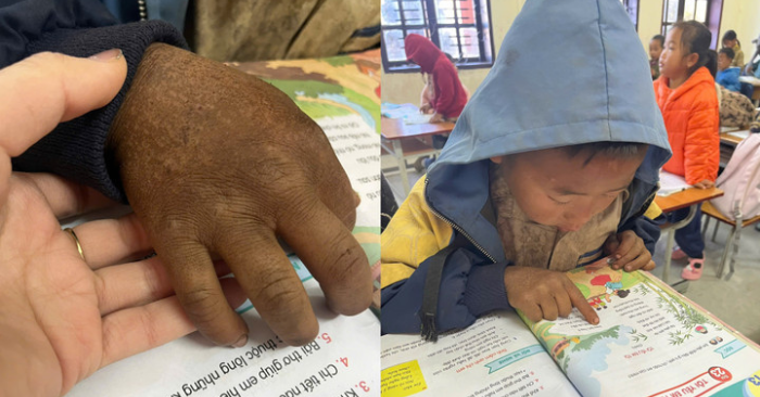 Bàn Tay Bé 8 Tuổi Lay Động Triệu Người