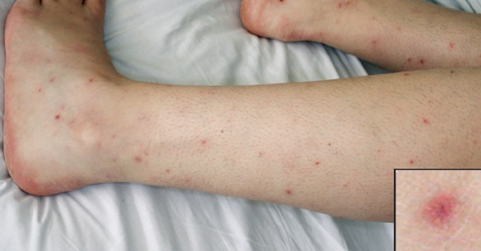 Số ca bệnh do não mô cầu tăng mạnh trên cả nước