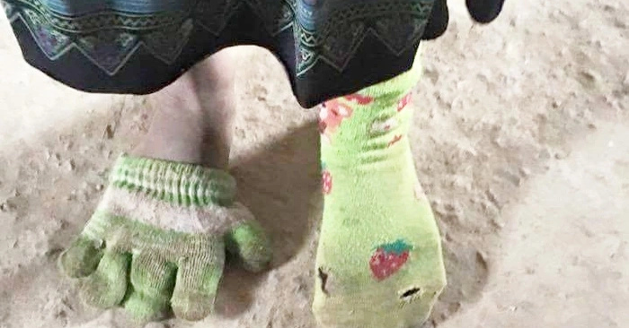 Bàn Tay Bé 8 Tuổi Lay Động Triệu Người