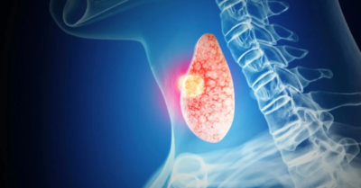 Loại ung thư có số ca mắc mới cao nhất tại Bệnh viện Ung bướu TP.HCM