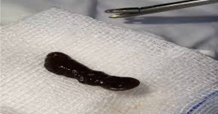 Con vắt trong mũi trẻ em gây nguy hiểm thế nào?