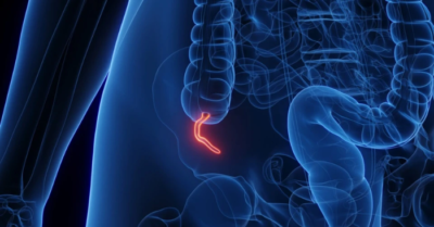 Ung thư ruột thừa hiếm gặp gia tăng đáng báo động ở người trẻ