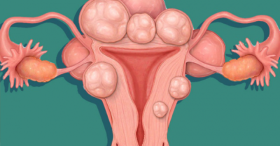 Mổ u xơ tử cung giảm đau, gọn gàng chỉ trong 2 giờ