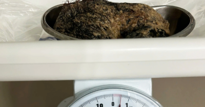 Sốc: Nửa cân tóc trong dạ dày bé 6 tuổi mắc Hội chứng Rapunzel hiếm gặp