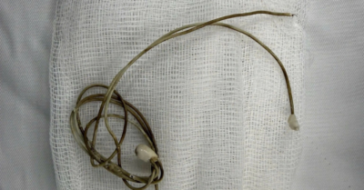 Sốc: Dây sạc điện thoại trong bàng quang vì mù quáng bắt chước video mạng