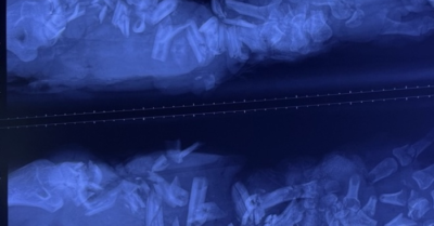 Người đàn ông nhập viện với cánh tay dập nát, bác sĩ buộc phải cắt cụt chi sau tai nạn lao động nghiêm trọng