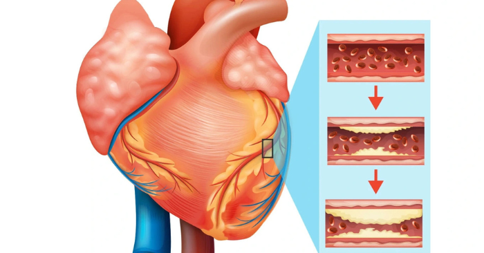 Bệnh mạch vành: Xu hướng điều trị ngày càng cá thể hóa
