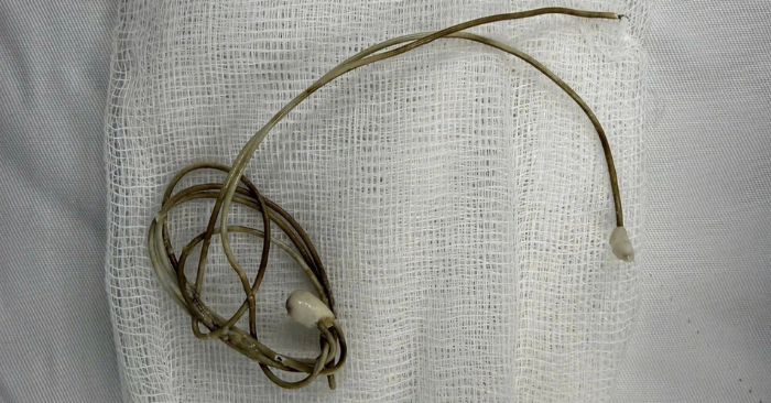 Dây sạc trong bàng quang: Cảnh báo từ ca bệnh của nam sinh