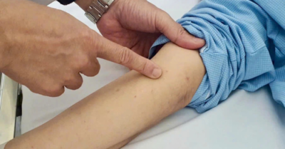 Dấu hiệu mắc não mô cầu có thể tử vong nhanh