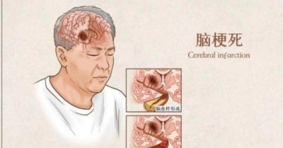 Tại sao đột quỵ ngày càng xảy ra thường xuyên hơn? Điều này không liên quan đến thịt mỡ; nên sử dụng ba loại gia vị này một cách tiết kiệm