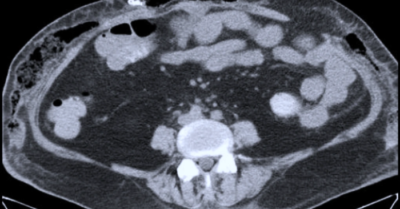 Người phụ nữ thủng ruột nguy kịch sau hút mỡ, 81 ngày chống chọi tử thần