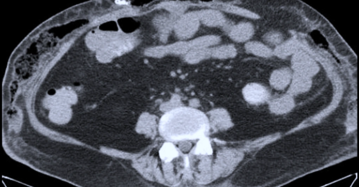 biến chứng hút mỡ