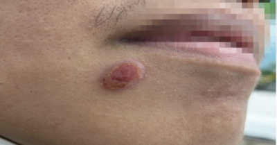 Nhiễm giang mai đồng giới tại TPHCM tăng mạnh