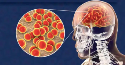 Ca bệnh não mô cầu tăng mạnh, nguy cơ tử vong trong 24 giờ