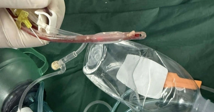 Bé 3 tuổi tử vong sau khi sặc thức ăn tại nhà trẻ: Cảnh báo về sơ cứu hóc dị vật ở trẻ nhỏ