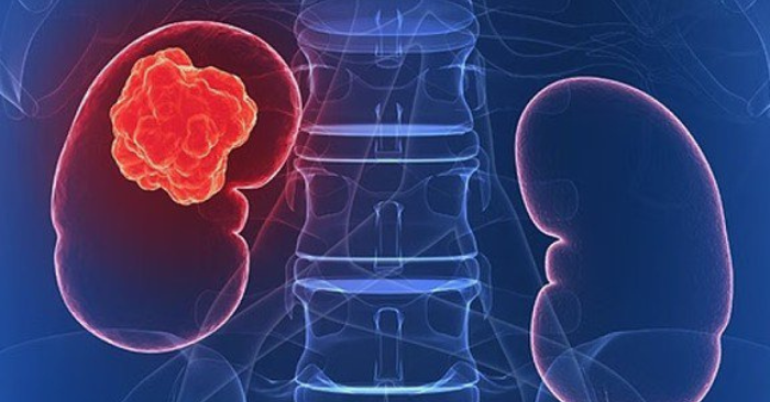 Thói quen hại thận: cảnh báo từ bé 8 tuổi qua đời