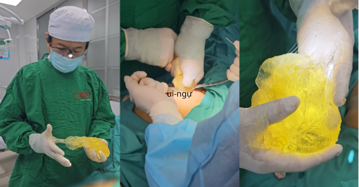 Phát hiện túi ngực vỡ sau 10 năm