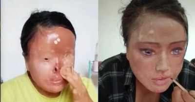 Bị chồng cũ tạt axit: Người phụ nữ Trung Quốc vẽ lại gương mặt