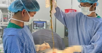 Phẫu thuật búi tóc lấy khối dị vật khổng lồ ở bé trai