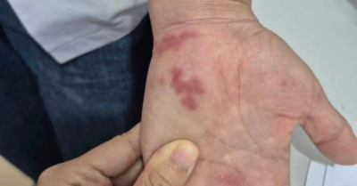 Bị vây cá đâm, người đàn ông nhiễm khuẩn nghiêm trọng do vi khuẩn nguy hiểm