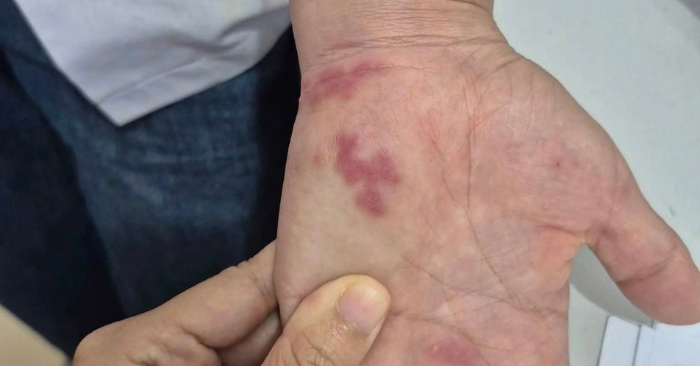 Bị vây cá đâm nhiễm khuẩn nguy hiểm