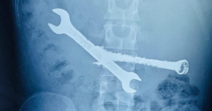 Bác sĩ lấy 2 cờ lê sắt: