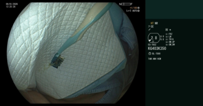 Bàn chải đánh răng kẹt trong dạ dày thiếu nữ