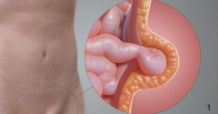 Bé gái quấy khóc vì khối phồng bẹn, cảnh báo phụ huynh không chủ quan