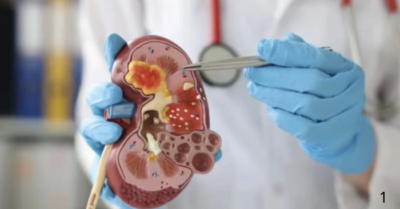 Bác sĩ cảnh báo thói quen uống nước điện giải phổ biến âm thầm gây hại thận