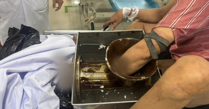 Chỉ vì không ngắt hoàn toàn nguồn điện khi vệ sinh máy xay thịt, một công nhân 40 tuổi đã gặp tai nạn lao động đặc biệt nghiêm trọng. Bàn tay bị cuốn nát trong lõi máy, buộc các bác sĩ phải cắt cụt cẳng tay để bảo toàn tính mạng