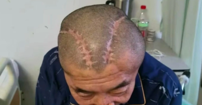 Bệnh viện Trung Quốc mổ nhầm bên não, gia đình yêu cầu bồi thường 10,5 tỷ đồng