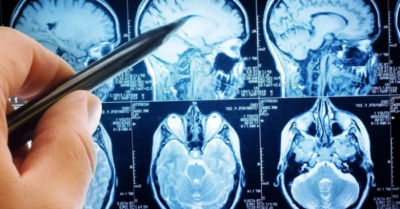 Ngã Đột quỵ khám bệnh được cứu sống trong giờ vàng