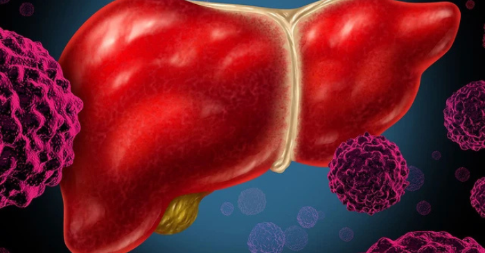 Chế độ ăn giàu chất béo: Thủ phạm âm thầm gây ung thư gan