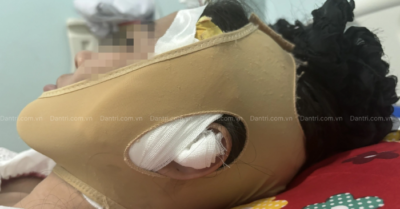 Cô gái biến dạng mặt sau tiêm filler ở TPHCM: “Tôi gọi nhưng spa đóng cửa”