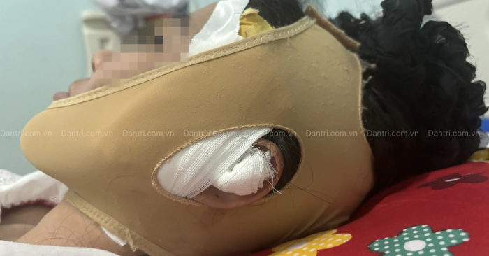 Sau tiêm filler, cô gái biến dạng mặt - Spa đóng cửa