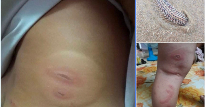 Sâu biển cắn bé 3 tuổi: Thực hư thông tin lan truyền