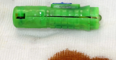 Dị vật ở âm đạo bé gái hoen rỉ gây viêm kéo dài