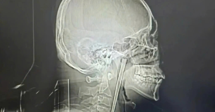 Phẫu thuật lấy chiếc đũa kim loại 12cm khỏi cổ họng người đàn ông