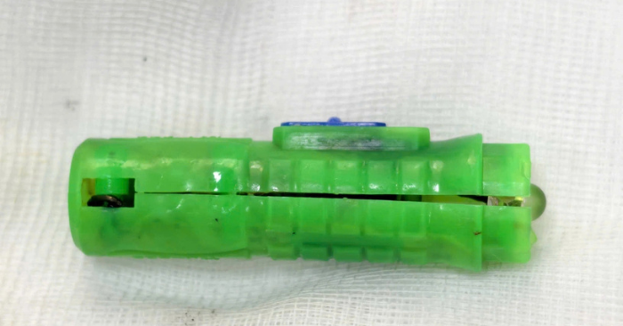 Hà Nội: Gắp dị vật đồ chơi trong âm đạo bé gái