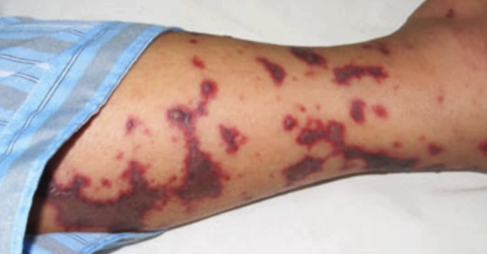 Não mô cầu khiến một bé gái tại Phú Quốc tử vong