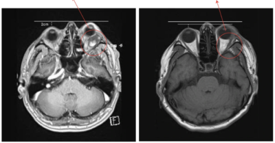 Phẫu thuật thành công khối u hốc mắt cho bệnh nhân nước ngoài tại Việt Nam