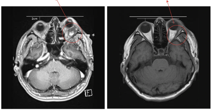 Phẫu thuật thành công khối u hốc mắt cho bệnh nhân nước ngoài tại Việt Nam