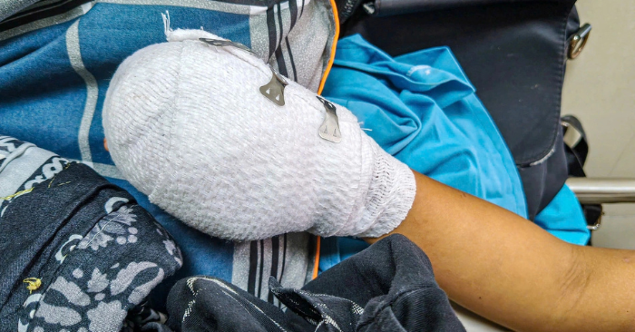 Bé trai tại Đà Nẵng nhập viện vì nghi điện thoại phát nổ