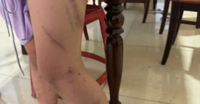 Đắk Lắk: Bé gái 9 tuổi mang 34 vết bầm nghi bị mẹ bạo hành