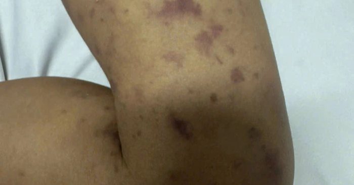 Viêm não mô cầu khiến bé trai 2 tuổi tử vong tại Đắk Lắk