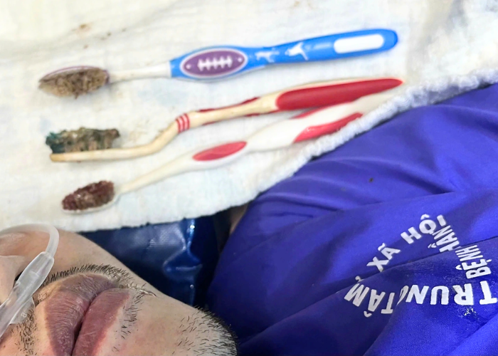Bác sỹ tại Huế gắp 3 bàn chải khỏi đường tiêu hóa cho bệnh nhân