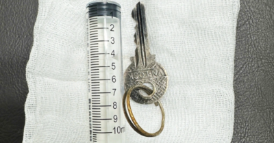 Nuốt dị vật: bác sĩ Quảng Ngãi lấy chìa khóa trong dạ dày trẻ