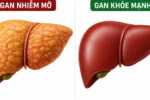 Vitamin B3 hỗ trợ điều trị gan nhiễm mỡ thông qua cơ chế tác động phân tử miR-93