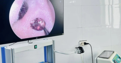 Nghệ An: Phát hiện ve chó nằm sâu trong tai người phụ nữ suốt một tuần