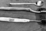 Bác sĩ Việt Đức mổ dạ dày lấy hai bàn chải và thìa inox